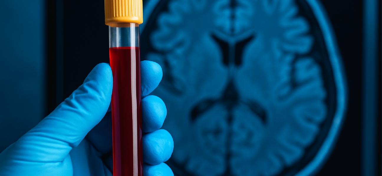 Imagem ilustrativa sobre Em estudo, exame de sangue revela sinais de Alzheimer décadas antes dos sintomas