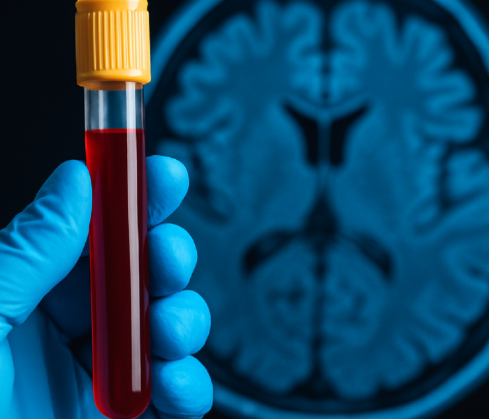 Imagem ilustrativa sobre Em estudo, exame de sangue revela sinais de Alzheimer décadas antes dos sintomas